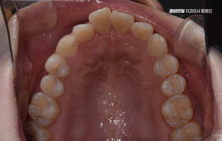 앞니 부분 교정 간단하니까 좋은건가요 관련 이미지 5