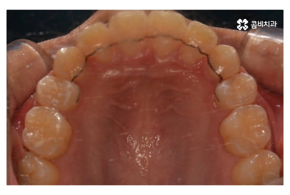 중학생치아교정 세심하게 체크하려면 관련 이미지 16