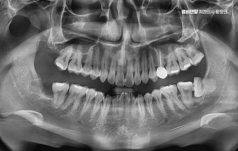 How to Systematically Prepare for Wisdom Tooth Extraction Due to Cavities image 8
