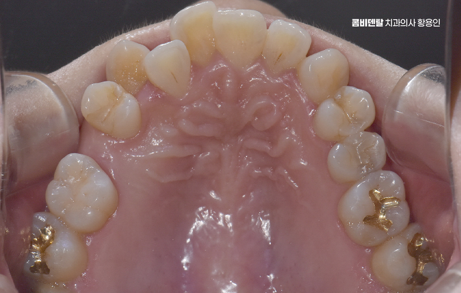 앞니 틀어짐 교정 조화롭게 마무리하려면 관련 이미지 5