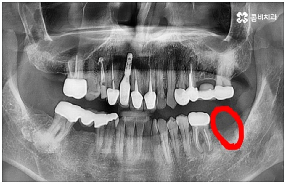 당일임플란트 나도 할수있나요 관련 이미지 2