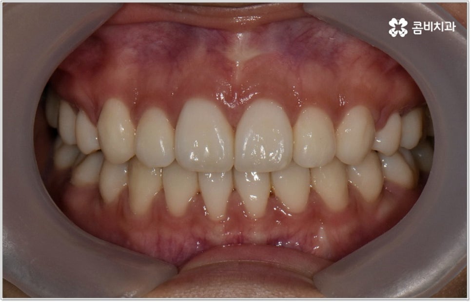 돌출입치아교정 언제가 적기인가요? 관련 이미지 10