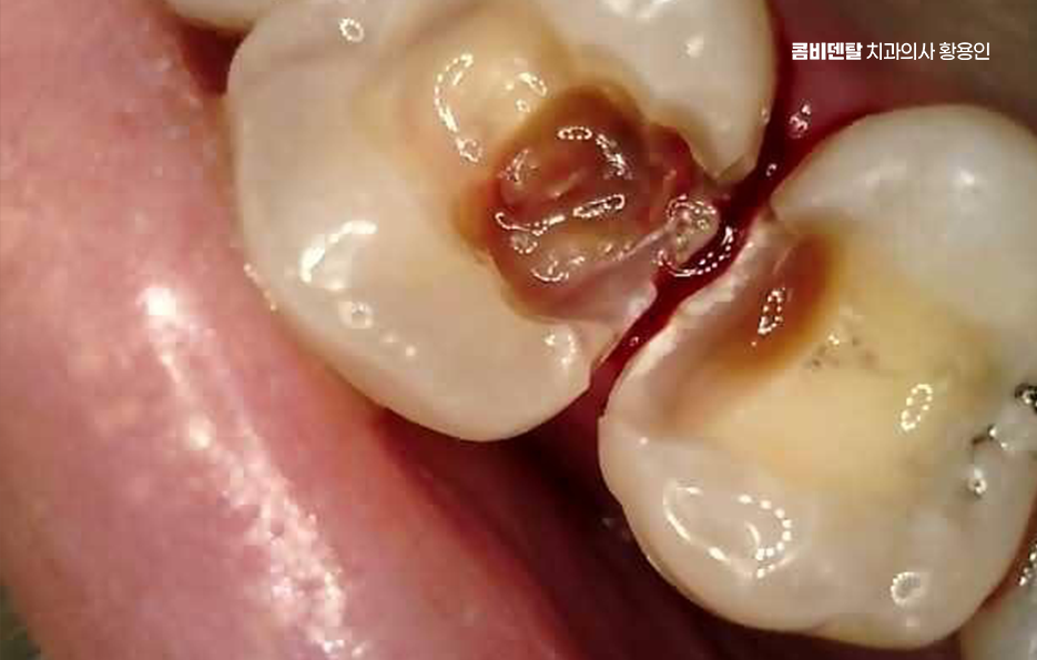 아말감 교체 레진 인레이 어떻게 대처하면 될까 관련 이미지 9
