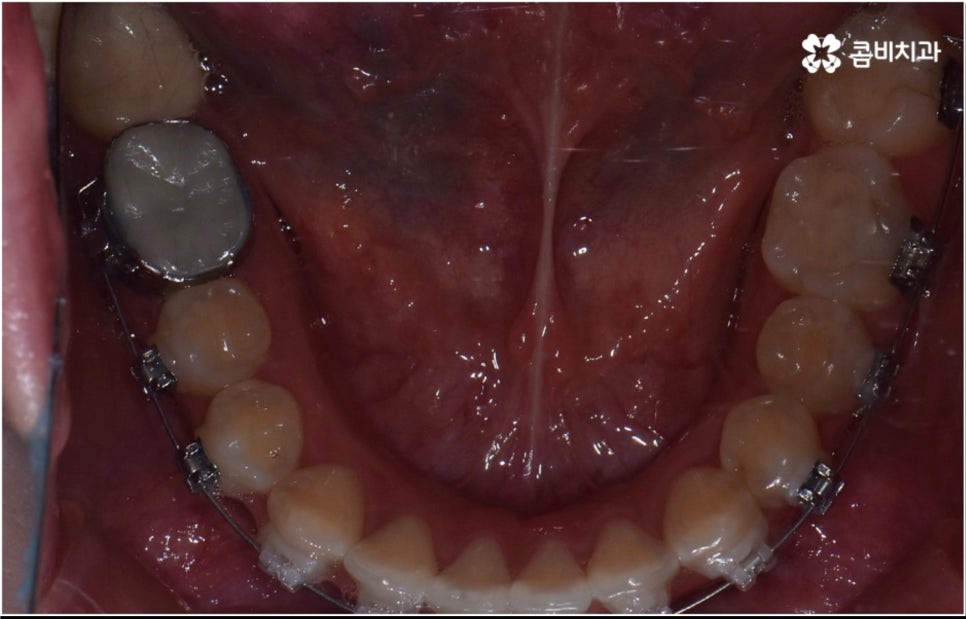 성인 치아교정 기간 걱정이 앞서나요 관련 이미지 12