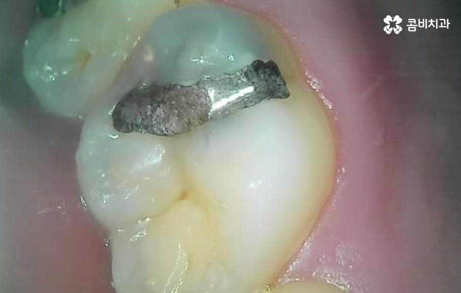 어금니 충치 깨짐 판단기준부터 세워보세요 관련 이미지 3