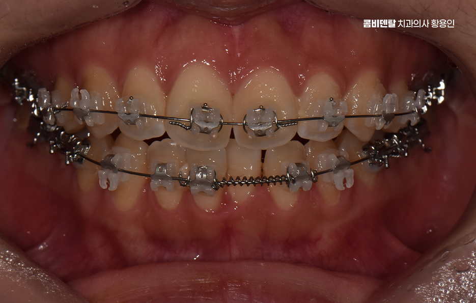 How Can You Determine the Duration of Front Teeth Orthodontic Treatment? image 7