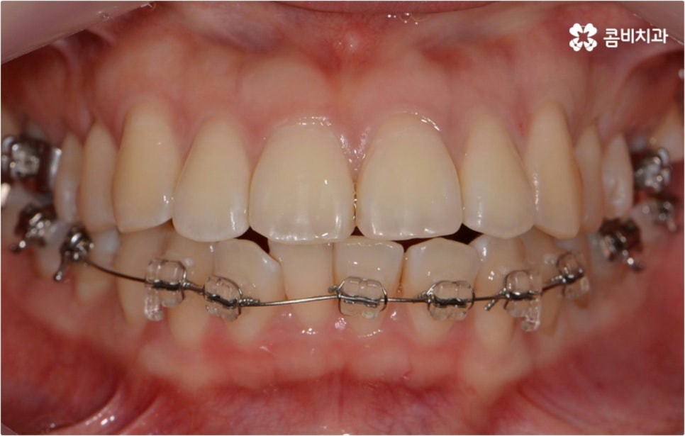 돌출입 치아교정 부모와 아이가 함께 알아봐요 관련 이미지 1