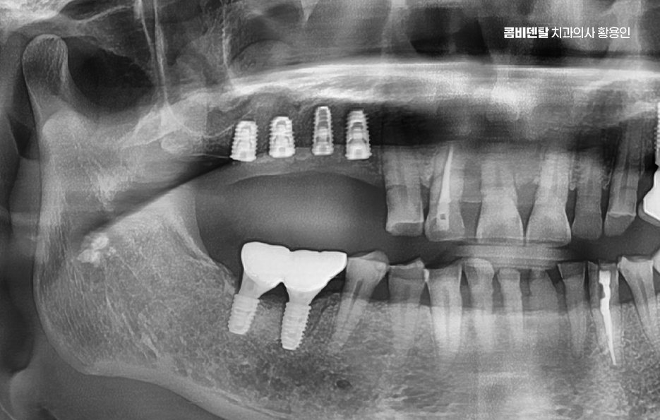 어금니 임플란트 과정 제대로 이해하려면 관련 이미지 10