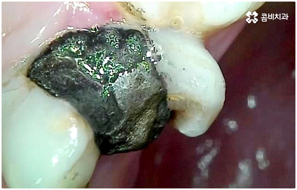 명동치과 평소에 케어하기 관련 이미지 2