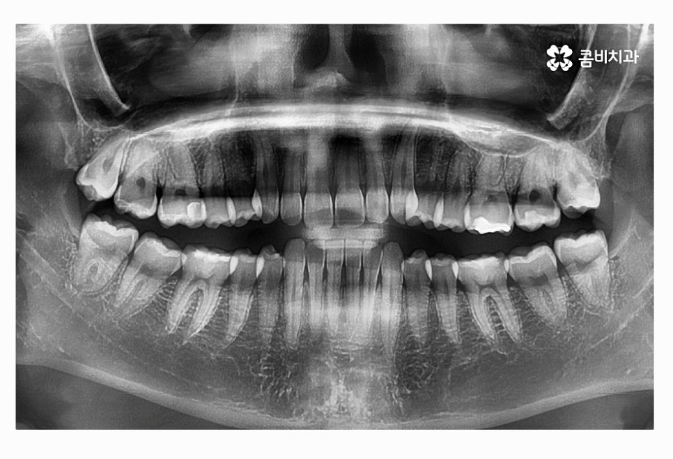 사랑니 충치 현명하게 접근하려면 관련 이미지 4