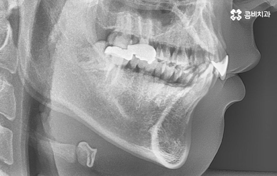 아랫니교정 이렇게만 파악하시면 됩니다 관련 이미지 7