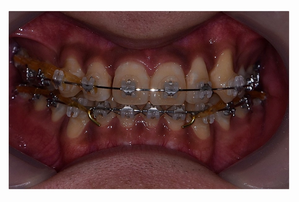 덧니 발치 필수적으로 하는건가요 관련 이미지 15