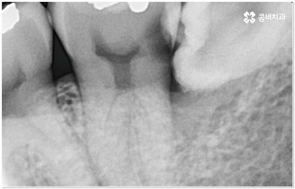 치아 사이 충치 어떻게 하나요 관련 이미지 7