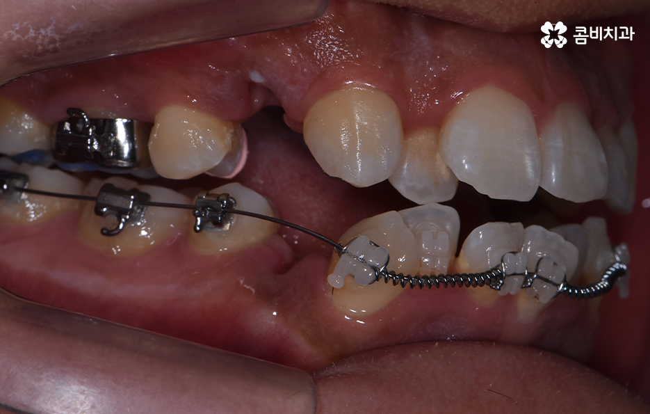 덧니 발치 교정 현명하게 선택하려면 관련 이미지 9