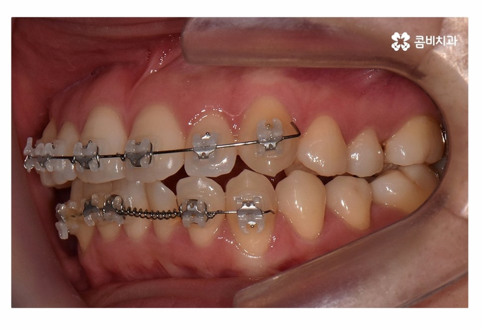 치아부분교정 나도 해당될지 궁금하다면 관련 이미지 9