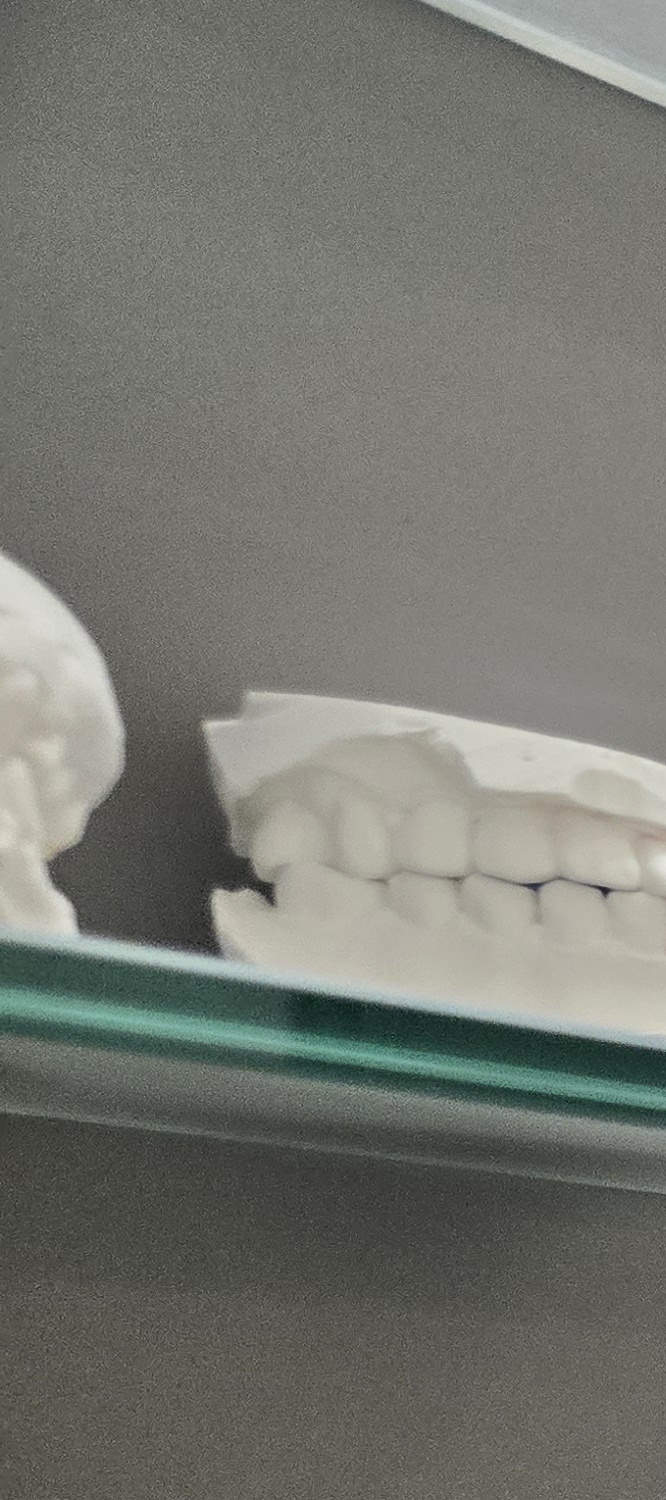 오래된 보철물 아말감 교체 어떠한 케이스일까 관련 이미지 10