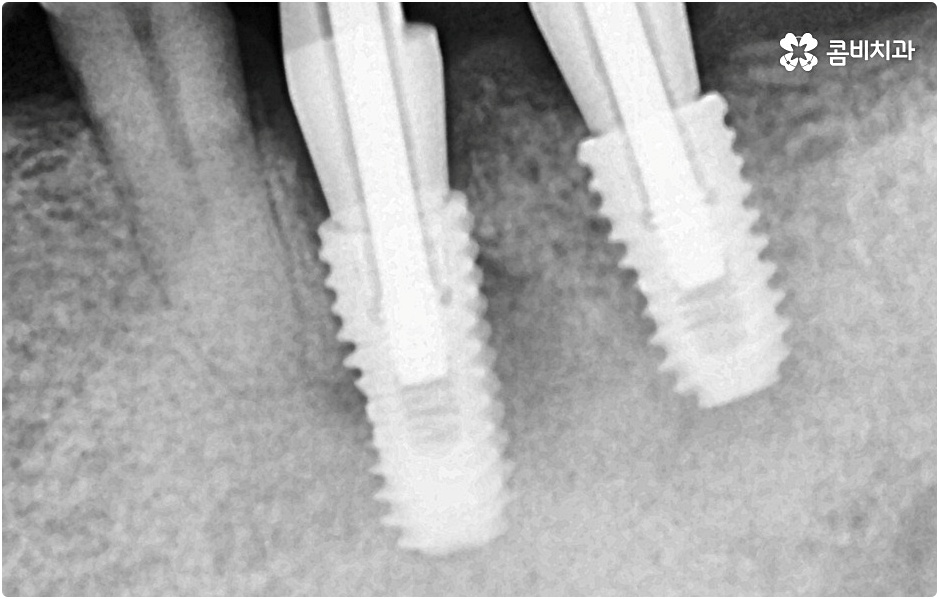 20대임플란트 남의일이 아니라면 관련 이미지 6