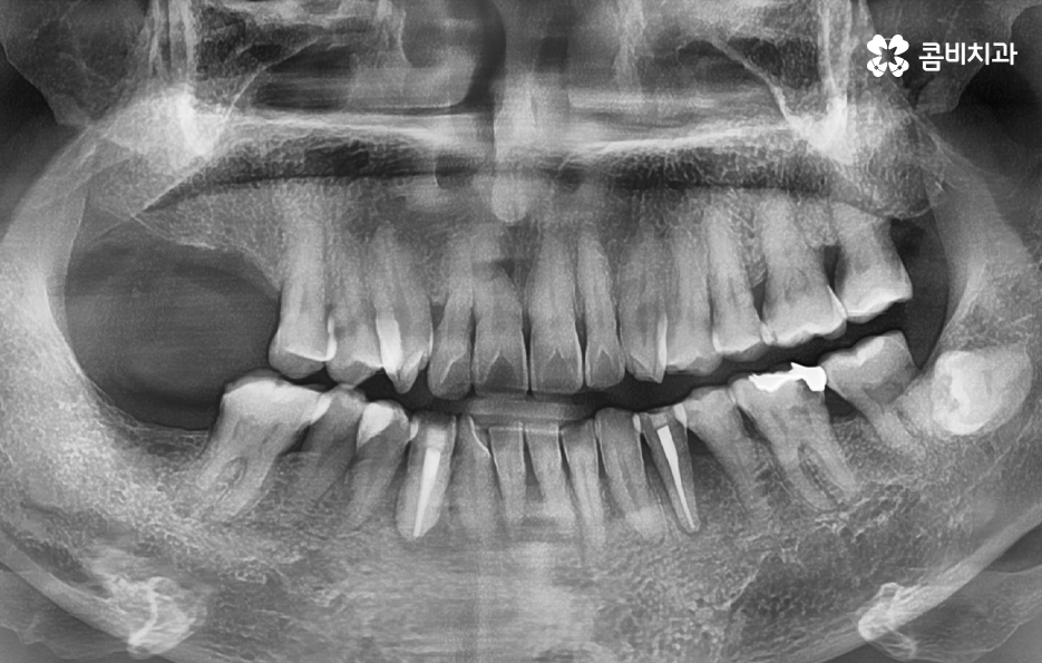 어금니 임플란트 기간 얼마나 예상해야 하나요 관련 이미지 1
