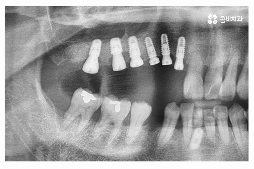 임플란트 수술 신중하게 결정하려면 관련 이미지 7