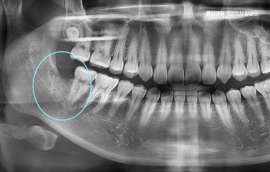 명동치과 흔하게 놓치는 사례를 정리해요 관련 이미지 11