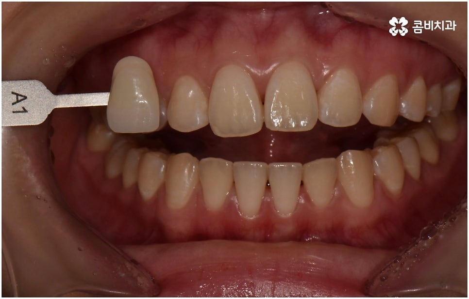 누런치아 하얗게 바꾸고 싶다면 관련 이미지 7