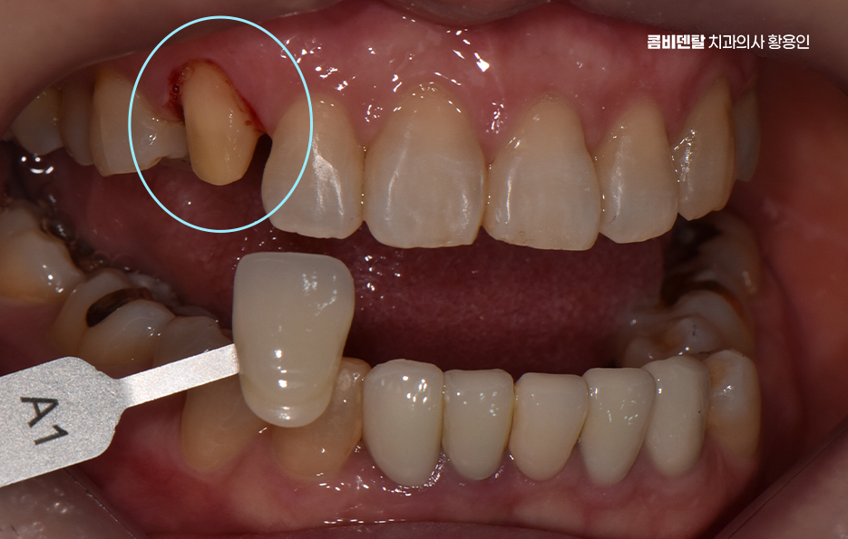 송곳니 크라운 티가 안나게 해결 가능한건가요 관련 이미지 2