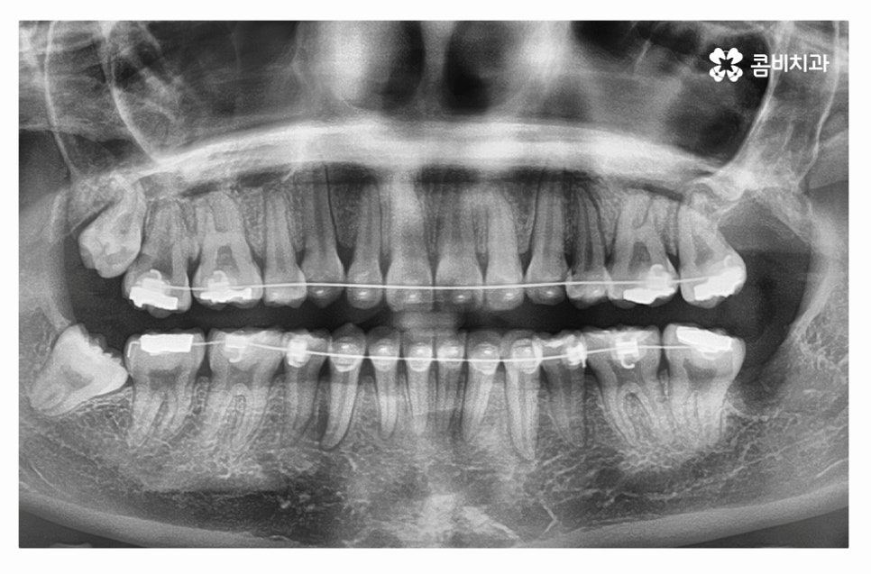 누운사랑니발치 언제 뽑을지 고민이라면 관련 이미지 3
