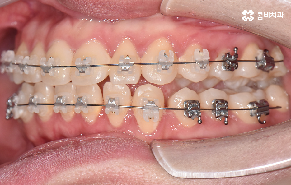 아래앞니 벌어짐 교정으로 해결했어요 관련 이미지 9