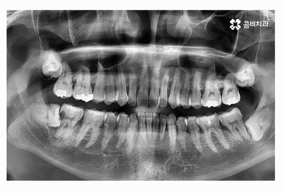 사랑니 충치 현명하게 접근하려면 관련 이미지 1