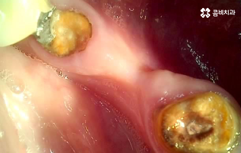 임플란트 치조골 상태에 따라 치료 계획도 달라지나요 관련 이미지 2