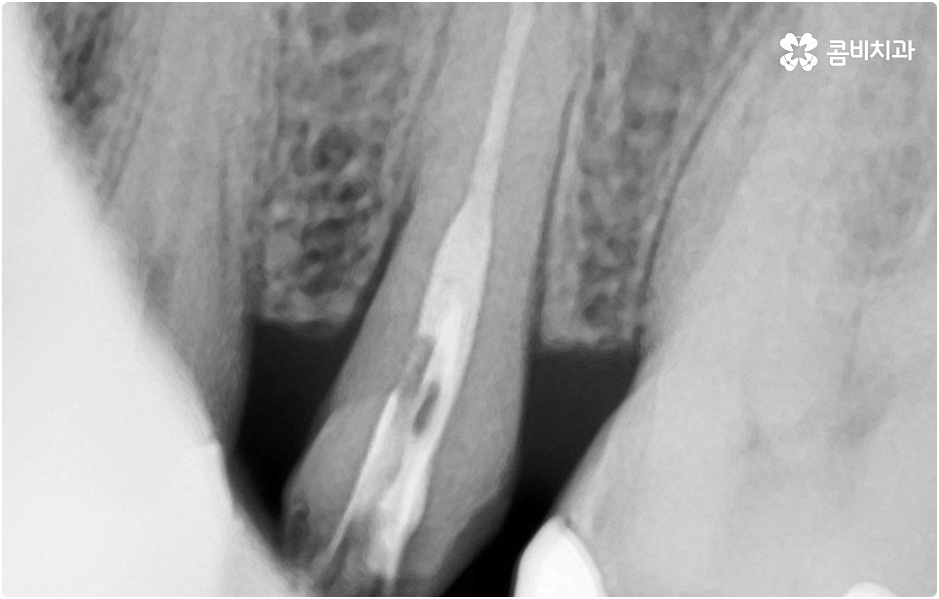 20대임플란트 남의일이 아니라면 관련 이미지 3