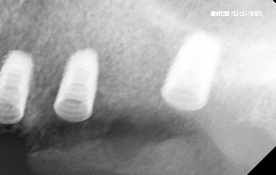 50대임플란트 꼼꼼하게 따져봐야할 포인트는 관련 이미지 5