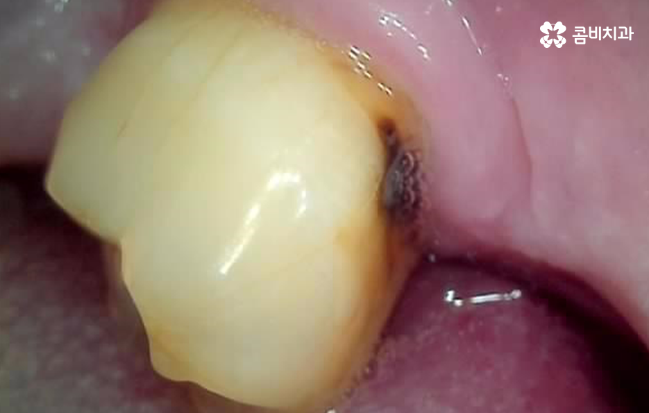 노인임플란트 이때부터 특히 조심하세요 관련 이미지 2