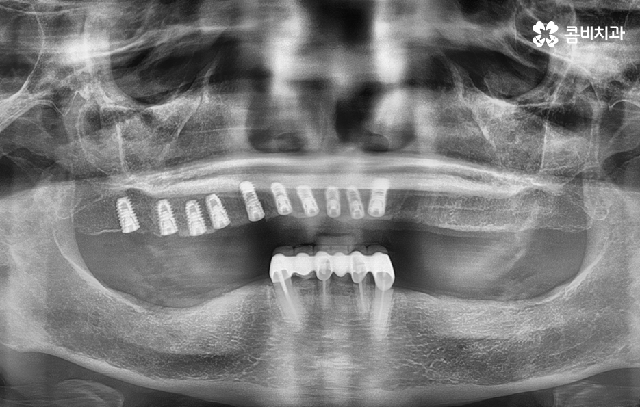 65세이상임플란트 고령이기에 간과하지 말아야 할 사항은 관련 이미지 3
