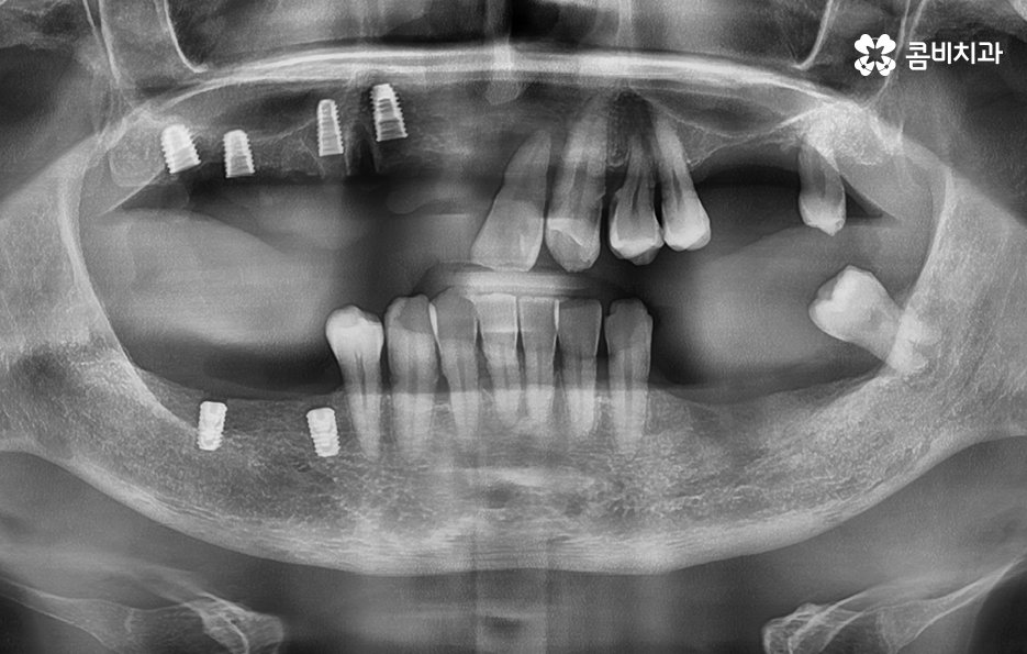 65세이상 임플란트 개수 구체적으로 체크하려면 관련 이미지 6