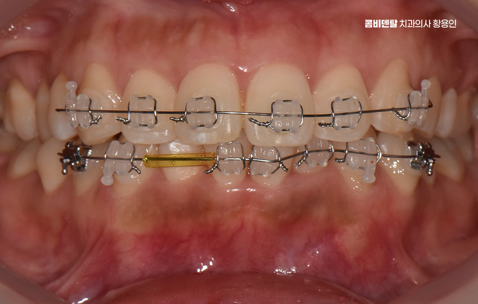 앞니 부분 교정 간단하니까 좋은건가요 관련 이미지 7