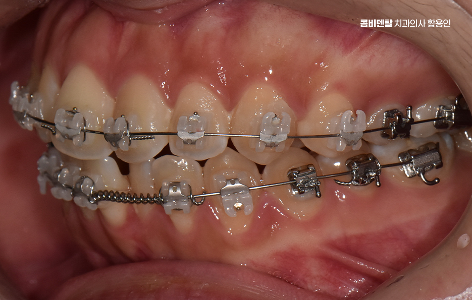 How Can You Determine the Duration of Front Teeth Orthodontic Treatment? image 9