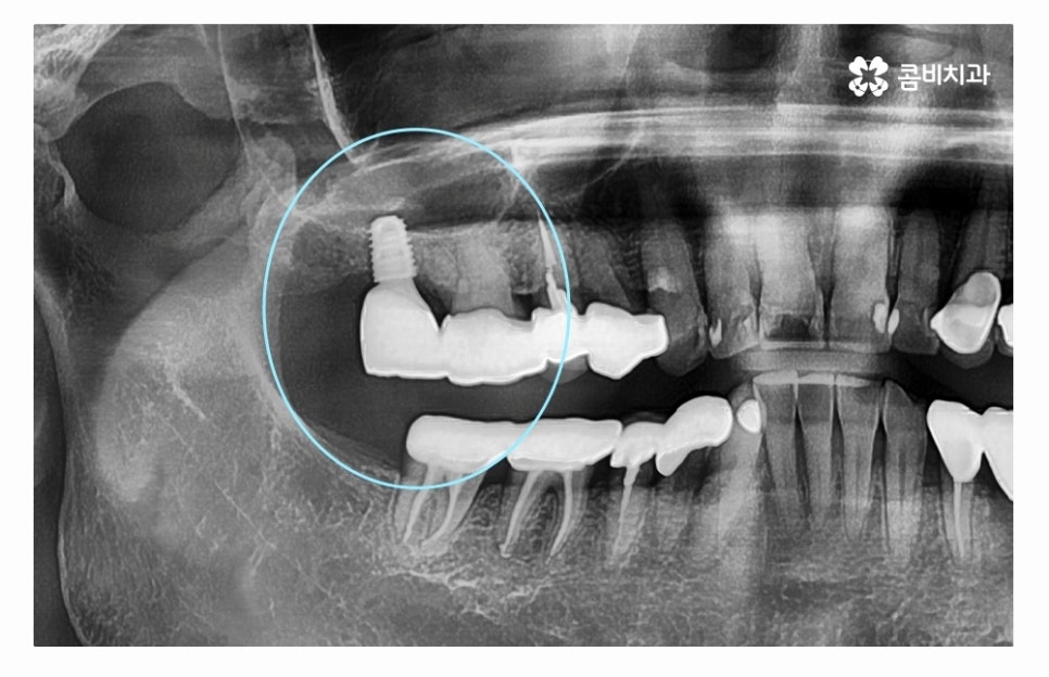 임플란트수술 제대로 알고 선택하려면 관련 이미지 9