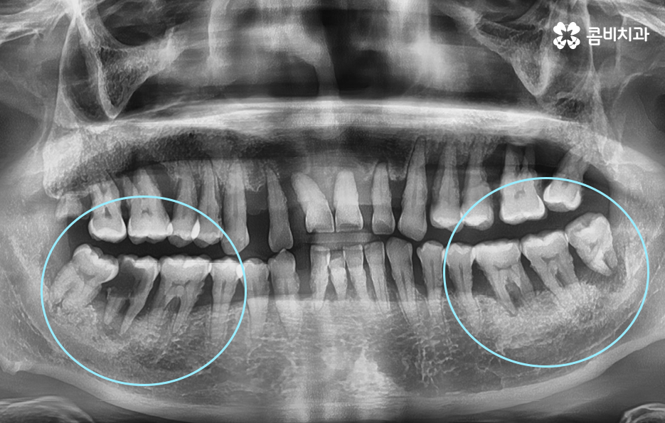 건강보험 임플란트 적용 받기 전에 알아두세요 관련 이미지 1