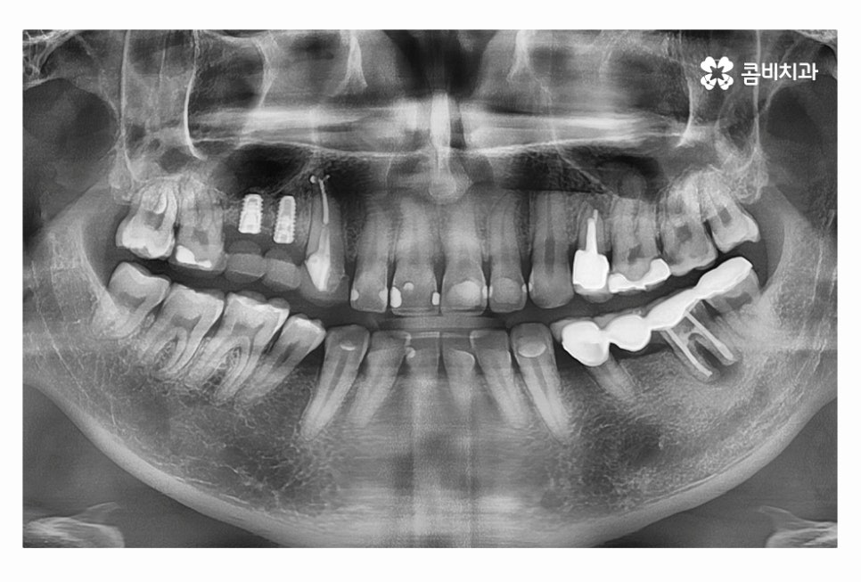 20대임플란트 갈수록 늘어나는 이유는 관련 이미지 9