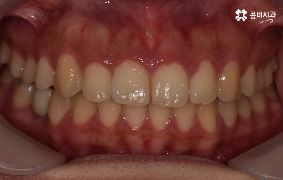 덧니 발치 교정 이런 경우에는 필요합니다 관련 이미지 12