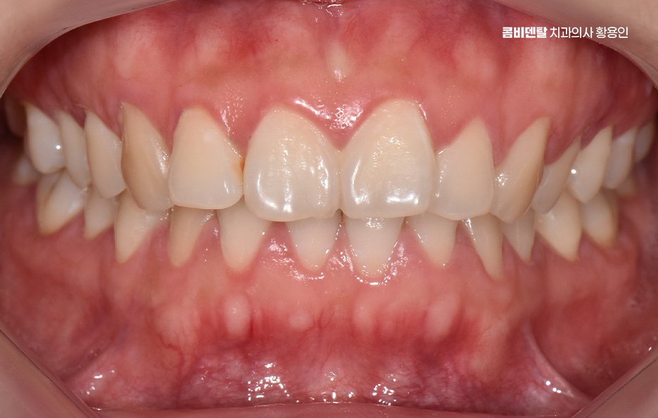 돌출입 팔자주름 교정 얼마나 바뀔까요 관련 이미지 1