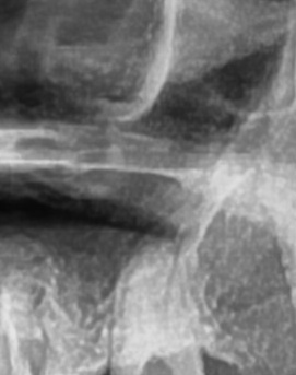 어금니 뒤 잇몸 부음 어떤 문제길래 이런거죠 관련 이미지 25
