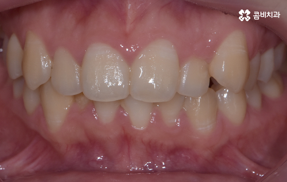 덧니 비발치 교정 자연스럽게 가능한 경우도 있어요 관련 이미지 1