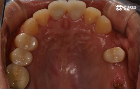 명동치과 타고난 이의 수명은 관련 이미지 4
