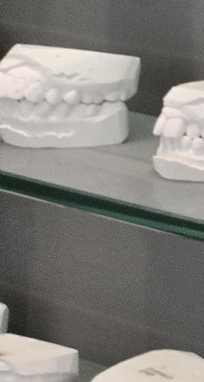 윗니 전체 임플란트 뭐부터 해야할까 관련 이미지 30