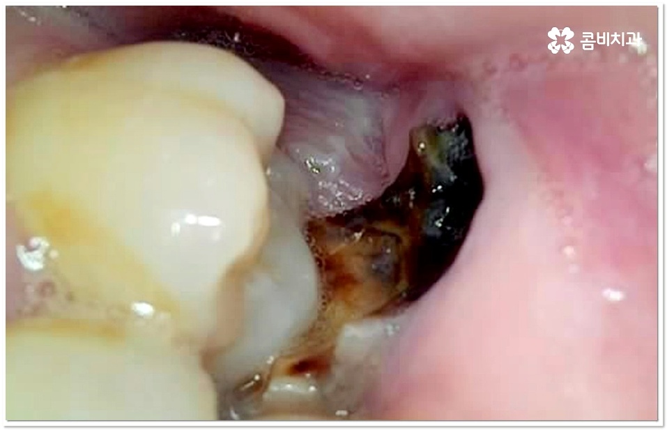 어금니 충치치료 빠를수록 좋아요 관련 이미지 7