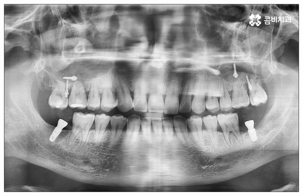 건강보험임플란트 혜택받아 보세요 관련 이미지 1