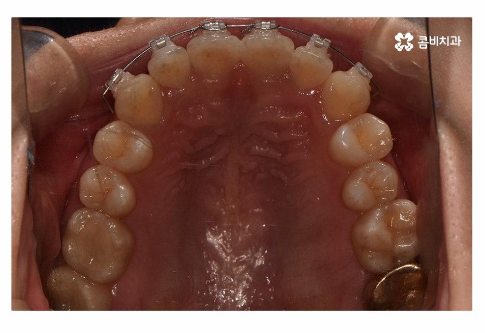 치아부분교정 나도 해당될지 궁금하다면 관련 이미지 10