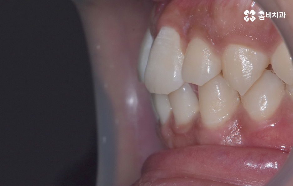 앞니만 교정 과잉치 뽑아서 해결했어요 관련 이미지 4